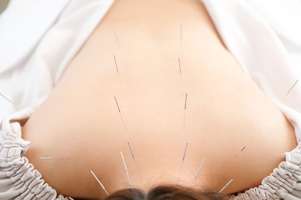Acupuncture needles placed along a client's back